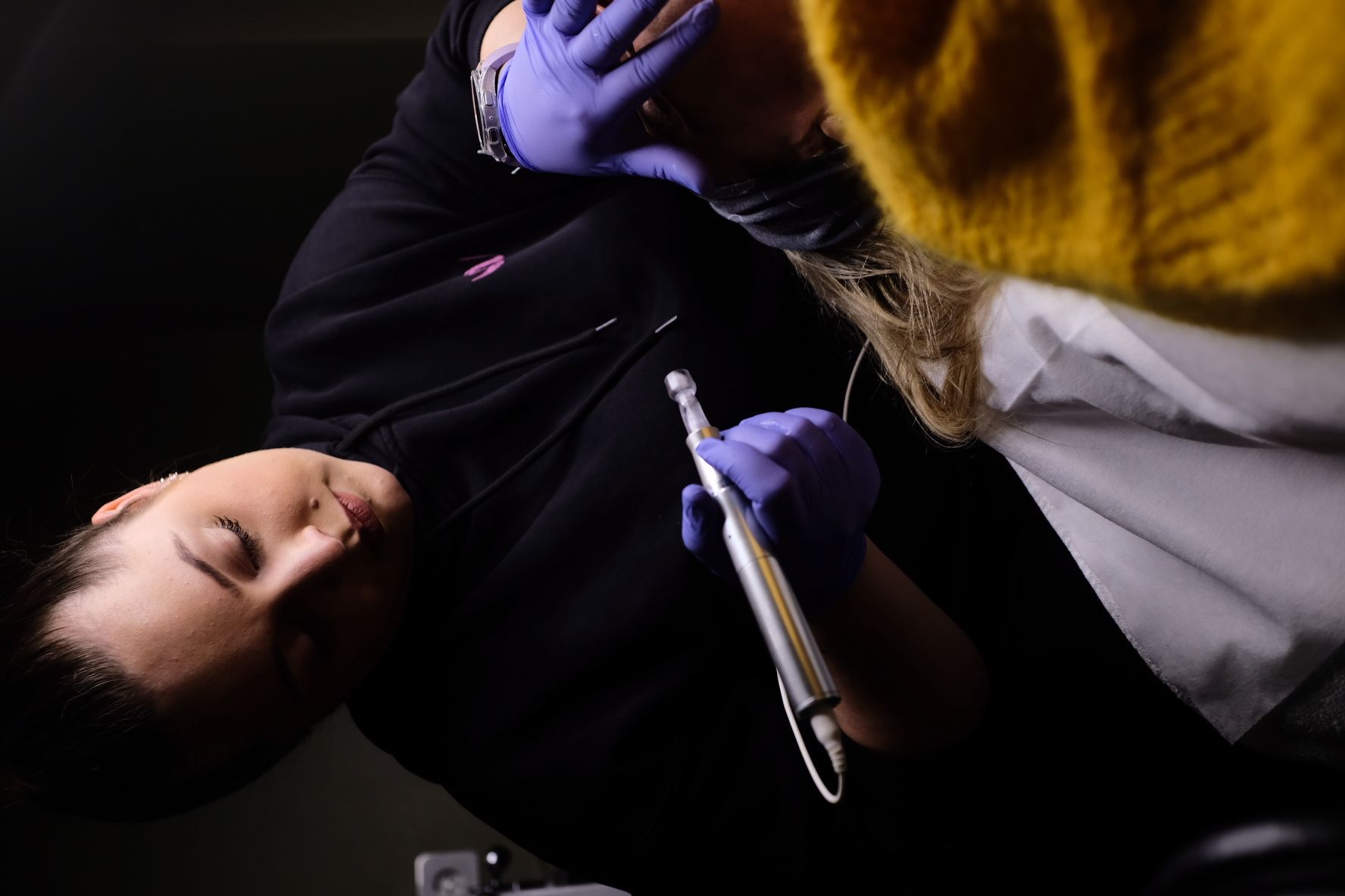 Microneedling1